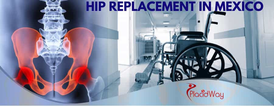 Hip Replacement surgery in Mexico